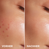 Anti-Unreinheiten-Serum